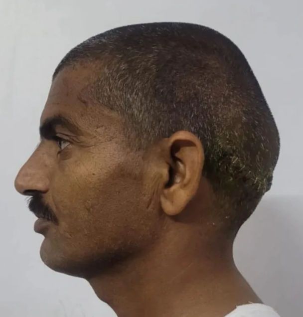 Чоловіку, який жив із "двома головами" 15 років, видалили величезну пухлину – фото до і після
