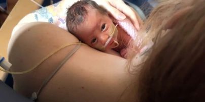 Дитина народилася із внутрішніми органами зовні тіла (фото)
