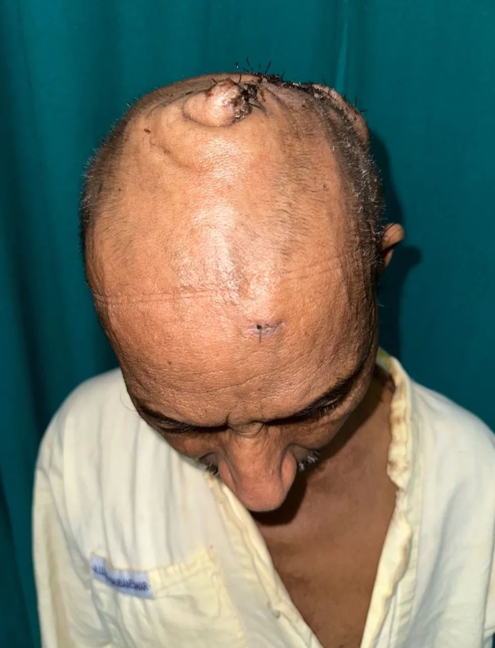 Чоловікові видалили 7-кілограмову пухлину на голові, з якою він жив 20 років: фото до і після
