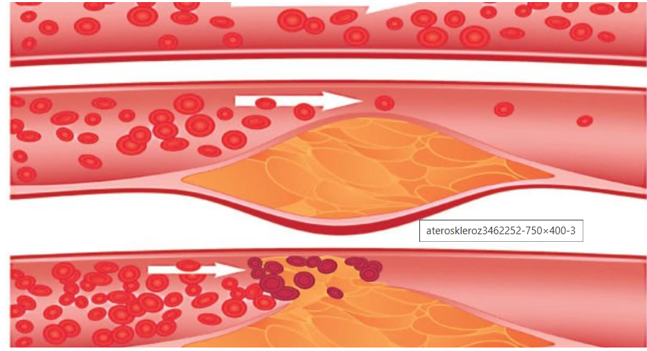 Ученые разработали новый подход к лечению атеросклероза