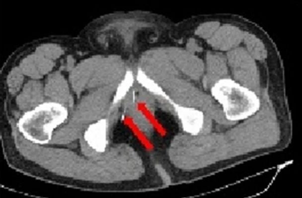 Китаєць встромив у пеніс дві великі голки / Фото: Basic and Clinical Andrology / © 