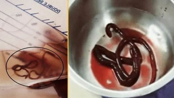 Нирковий черв’як Dioctophyma renale / Фото: Journal of Clinical and Diagnostic Research