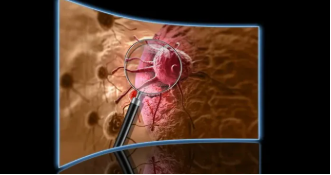 Чому в усьому світі різко зростають випадки раку щитовидної залози