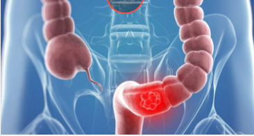 Названа найгірша дієта в плані ризику раку кишечника