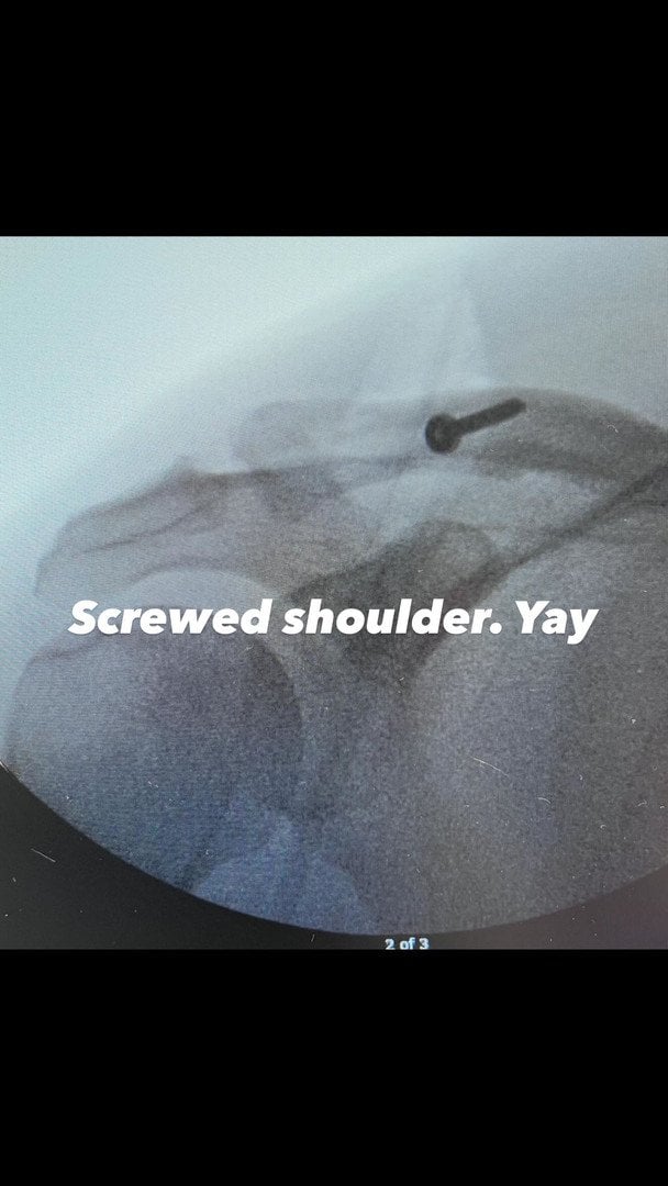 Плече Ченнінга Татума після операції / &copy; instagram.com/channingtatum