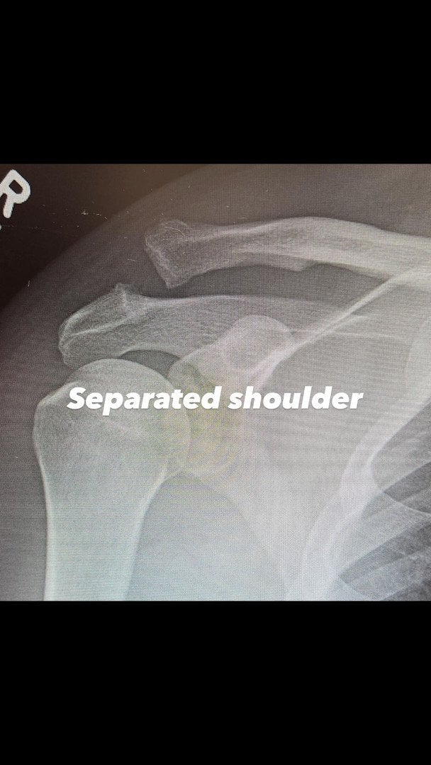 Плече Ченнінга Татума до операції / &copy; instagram.com/channingtatum