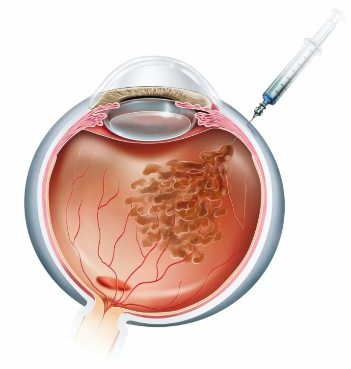 Эффективность препарата Айлия в лечении макулярных заболеваний