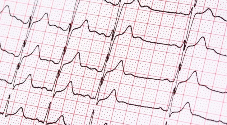 Медики назвали натуральний засіб від аритмії