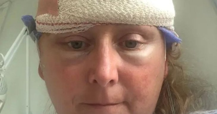 Жінка списувала симптоми на менопаузу, але лікарі виявили 10 пухлин мозку