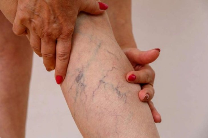 Тромбоз: лікарі з Німеччини розповіли, як розпізнати перші ознаки