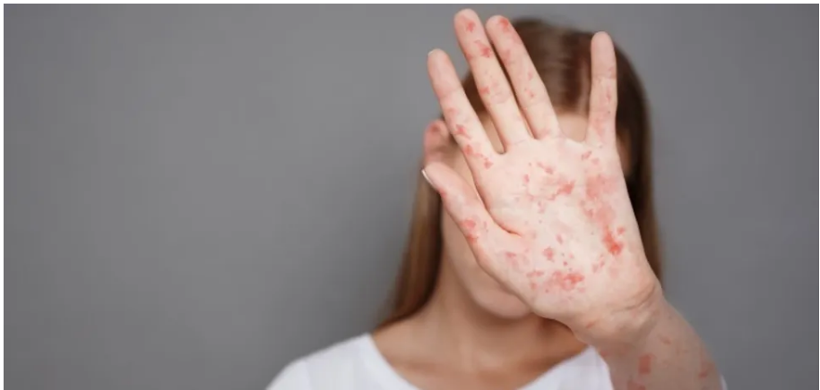 В одному з регіонів України ліквідували п'ять спалахів кору: більше 80% випадків хворіли діти