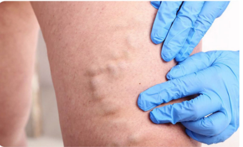 Основні симптоми варикозного розширення вен