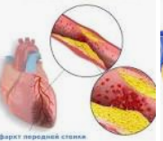 Спадковий ризик інфаркту: як зрозуміти, що хвороба батьків загрожує і вам