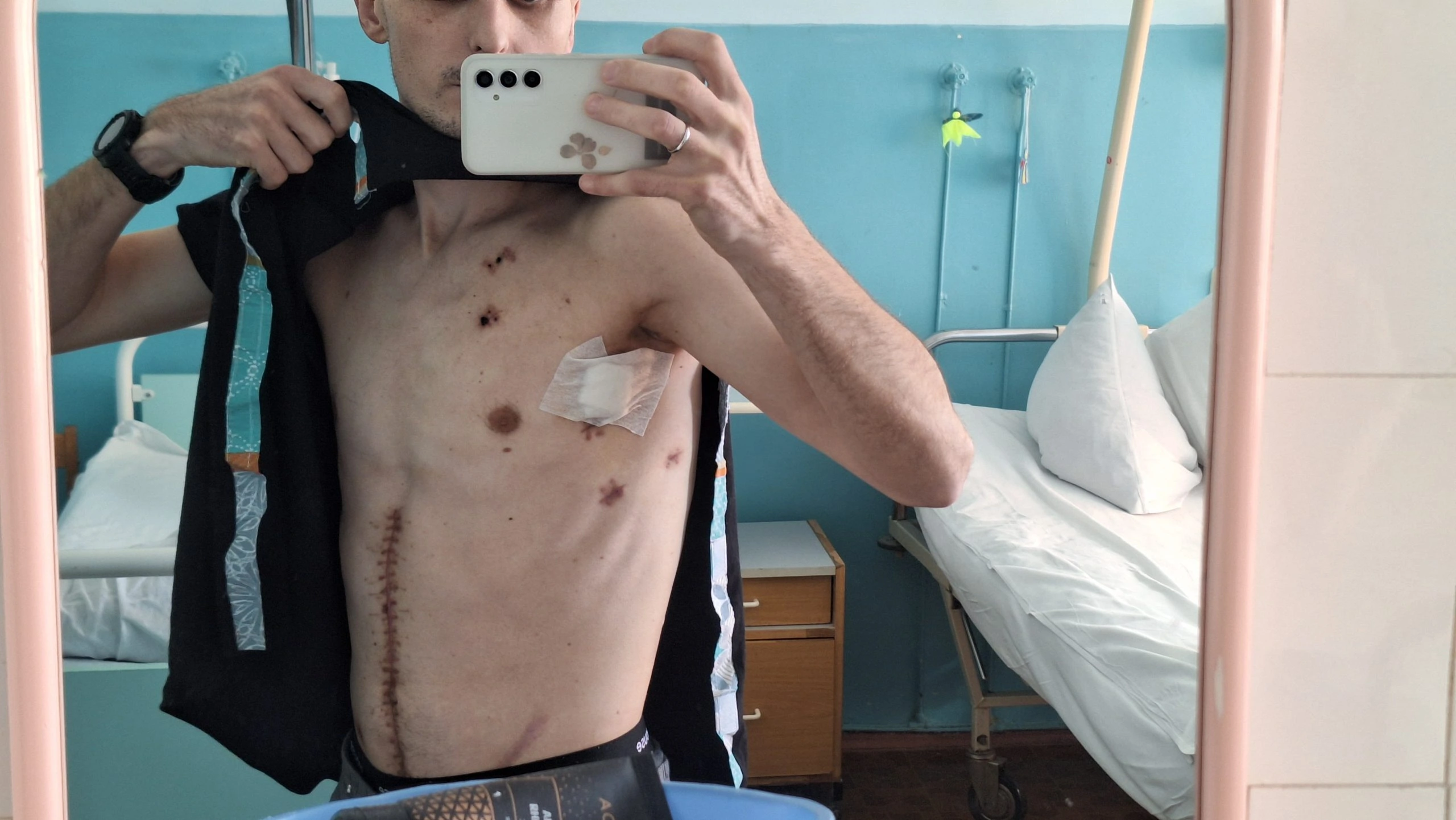 Зображення посту: Втратив 20 кілограмів і отримав майже 20 рубців: військовий із Лисичанська відновлюється після поранення