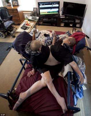 Как живется самым старым в мире сиамским близнецам. Фото