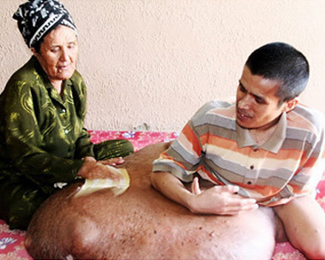 На ноге у вьетнамца выросла опухоль весом 80-килограммов