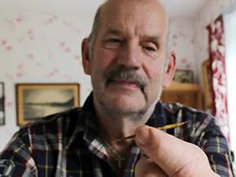 Швед прожил 25 лет с зубочисткой в животе