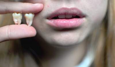 Стоматологи опровергли популярные мифы о зубах мудрости