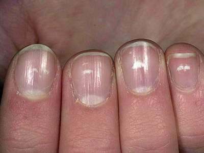 Эксперт рассказал, как распознать болезни по состоянию ногтей