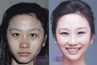 Чудеса медицины: ослепительные преображения азиаток. Фото