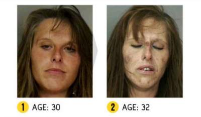 Результат на лицо: снимки людей, разрушивших себя наркотиками. Фото