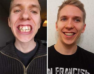 Ощутимая разница: как брекеты меняют улыбку. Фото