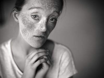 Девушка с редким заболеванием покорила нестандартной красотой. Фото 