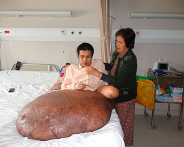 Врачи удалили вьетнамцу 90-килограммовую опухоль