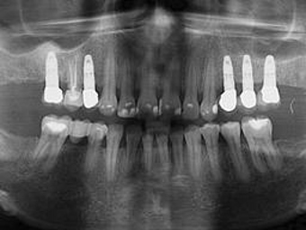Процесс приживления зубных имплантатов удалось ускорить