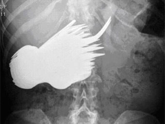 Рентгеновский снимок брюшной полости Маргарет Даалман