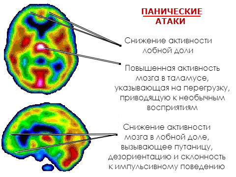 Панические атаки и тревожность связаны с дефицитом витамина В и железа