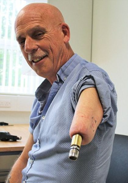 57-летнему британцу вживили бионический протез с кучей насадок