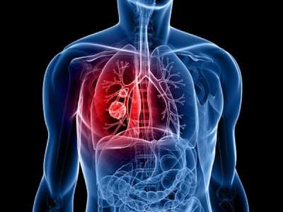 Онкологи назвали основные признаки рака легких