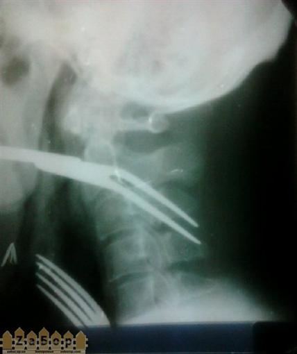 В Запорожье мужчина случайно проглотил две металлические вилки