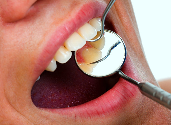 Грязные зубы ведут к слабоумию