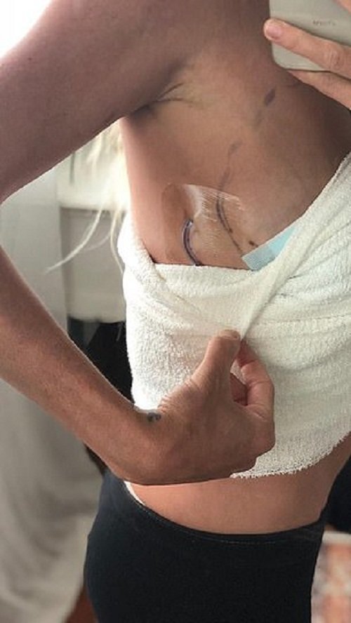 \"Жизнь превратилась в ад»: австралийка рассказала, почему избавилась от грудных имплантов