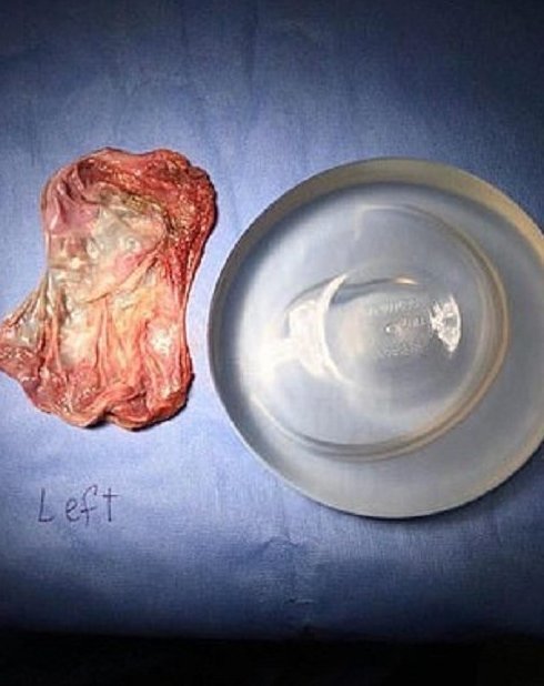 \"Жизнь превратилась в ад»: австралийка рассказала, почему избавилась от грудных имплантов