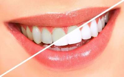 Как отбелить зубы в домашних условиях: эффективный способ