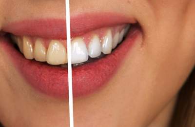 Названы главные причины пожелтения зубов