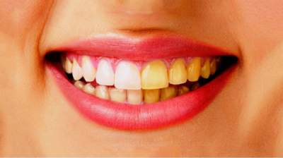 В чем причина желтизны зубов и как с ней справиться