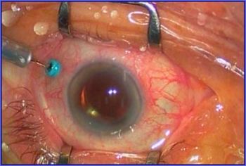 Ученые создали имплантат для починки сетчатки глаза