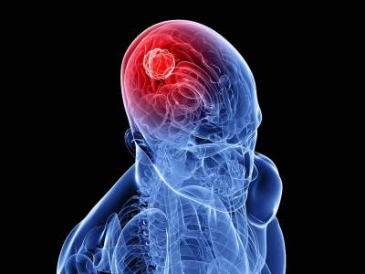 Медики назвали первые симптомы рака мозга