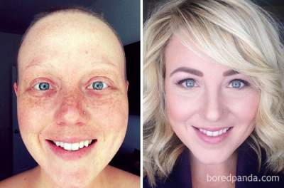 Впечатляющие преображения людей, победивших рак. Фото 