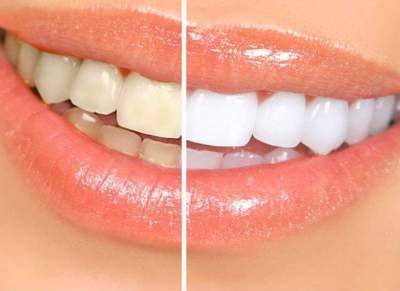 Стоматологи сообщили, кому опасно отбеливать зубы