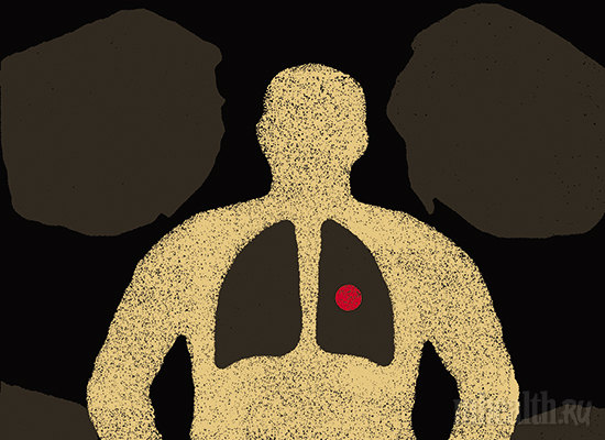 Туберкулез: что нужно знать?