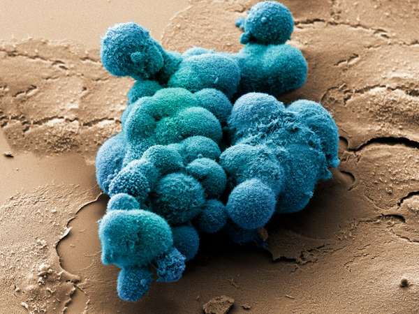Клетки рака поджелудочной железы, старающиеся сложиться в объёмную структуру