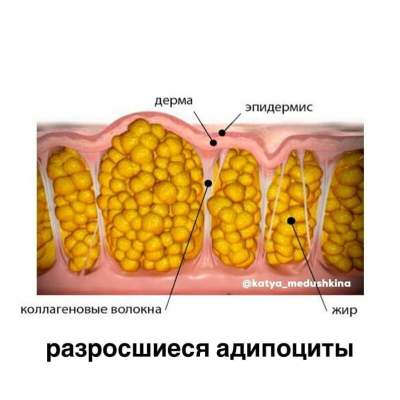 Стадии целлюлита фото как