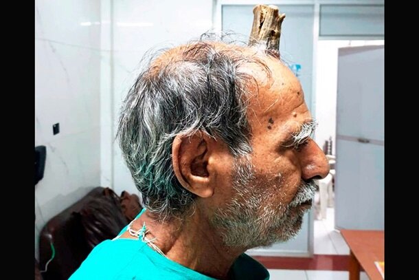 В Индии провели курьезную операцию, удалив мужчине рог. ФОТО