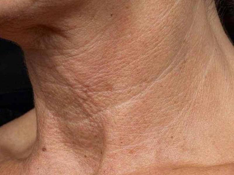 Как предотвратить старение кожи в области шеи