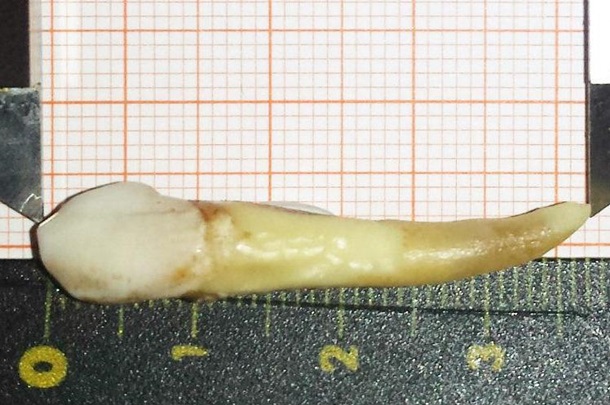 В Германии стоматолог удалил рекордно длинный зуб. Фото